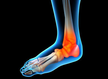 Sistema da placa do osso do pé